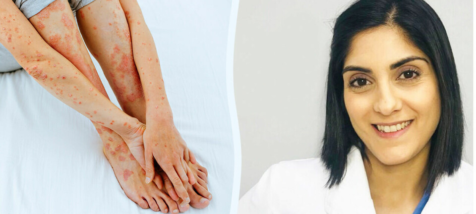 Hudläkaren förklarar: Så ska du ta hand om din psoriasis