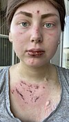 Amanda satte sig i solen, med solkräm men mot läkarens inrådan, somnade och fick svåra brännskador.