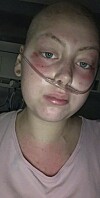 Det Amanda trodde var influena visade sig vara cancer.