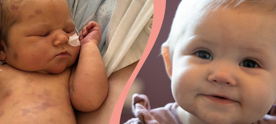 Lilla Alice föddes med cancer – var täckt av blåmärken