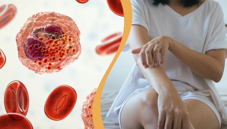 8 autoimmuna sjukdomar alla borde känna till