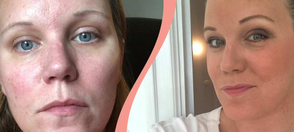 Anja har varit sjuk i covid-19 i ett halvår: ”Aldrig varit med om något liknande”
