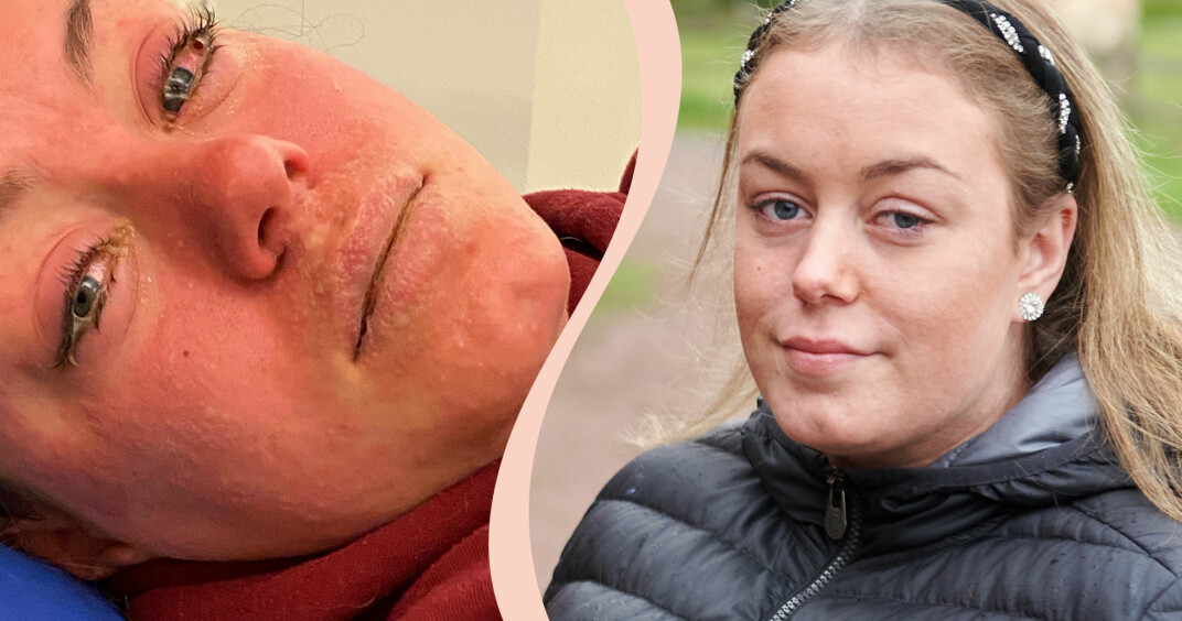 Alva, 17, fick livshotande sjukdom av vanligt läkemedel