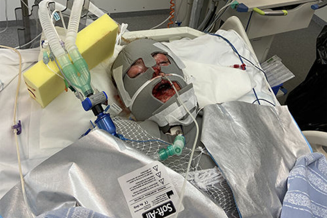 För att klara av det när smärtan var som värst fick Alva starka mediciner som hjälpte – men har gjort tiden på sjukhus till ett töcken. För att klara av det när smärtan var som värst fick Alva starka mediciner som hjälpte – men har gjort tiden på sjukhus till ett töcken.