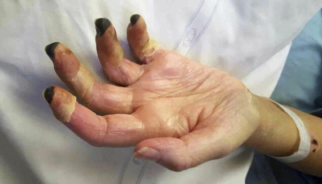 Evas fingertoppar blev helt svarta och den döda vävnaden måste amputeras. Evas fingertoppar blev helt svarta och den döda vävnaden måste amputeras.