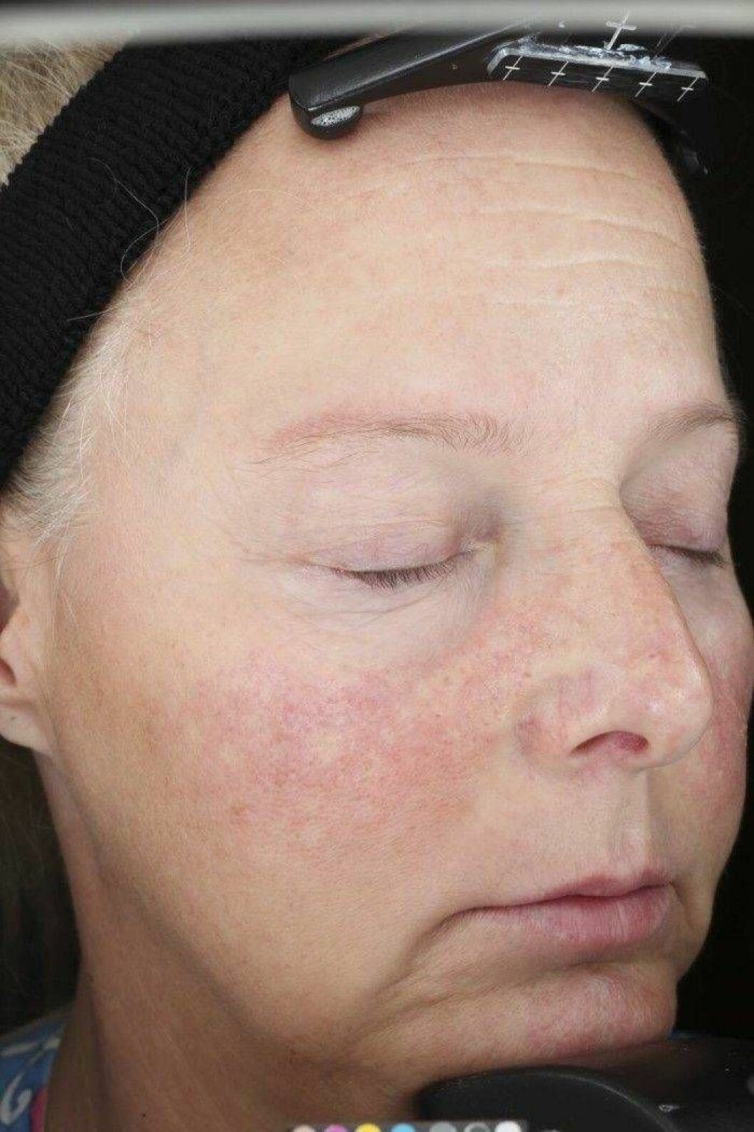 Kvinna före behandling med ny medicin mot rosacea