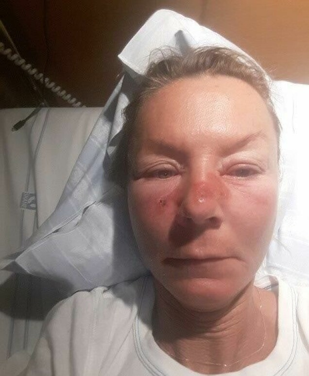Pia drabbades av rosfeber, en infektion i huden som orsakas av bakterier, och snart efteråt kom kollapsen som gjorde att hon fick läggas in på sjukhus. Pia drabbades av rosfeber, en infektion i huden som orsakas av bakterier, och snart efteråt kom kollapsen som gjorde att hon fick läggas in på sjukhus.