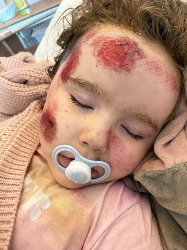Läkarna konstaterade att Alicia hade svåra sårskador på högra delen av ansiktet och på huvudet. Läkarna konstaterade att Alicia hade svåra sårskador på högra delen av ansiktet och på huvudet.