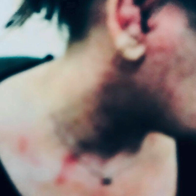 Saras skador dokumenterades och efter en tuff rättegång dömdes hennes förövare till fängelse i tre år och sex månader. Saras skador dokumenterades och efter en tuff rättegång dömdes hennes förövare till fängelse i tre år och sex månader.