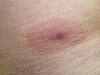 Ett rött märke på huden efter ett fästingbett – borrelia.