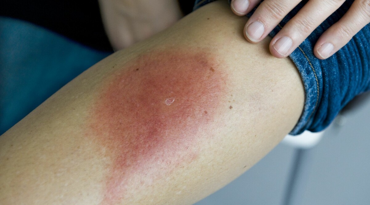 Så minskar du risken att få borrelia och TBE