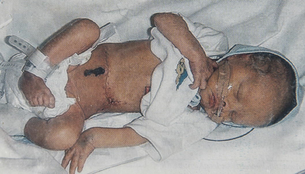 Ett långt ärr på Adams mage vittnade om våldet han utsatts för innan han ens hunnit komma till världen. Foto: Privat Lille Adam som skadades i en kvinattack när han låg i sin mammas mage.