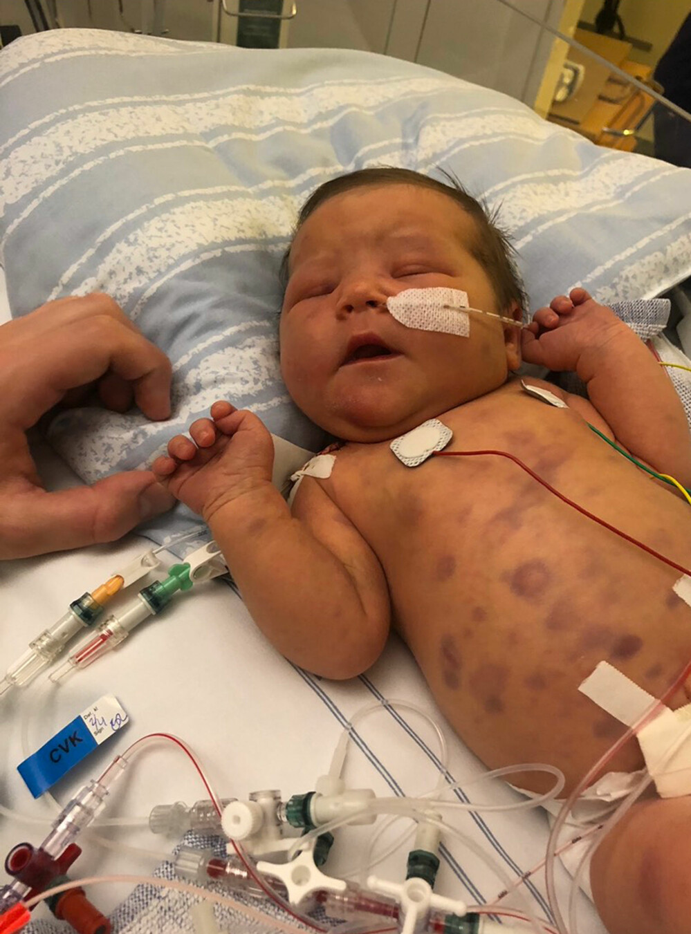 Alice var täckt av blåmärken när hon föddes. Foto: Privat Alice Ström föddes med cancer i april 2019.