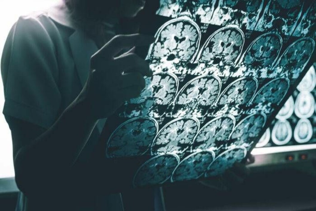 Foto: Shutterstock/IBL Alzheimers sjukdom.