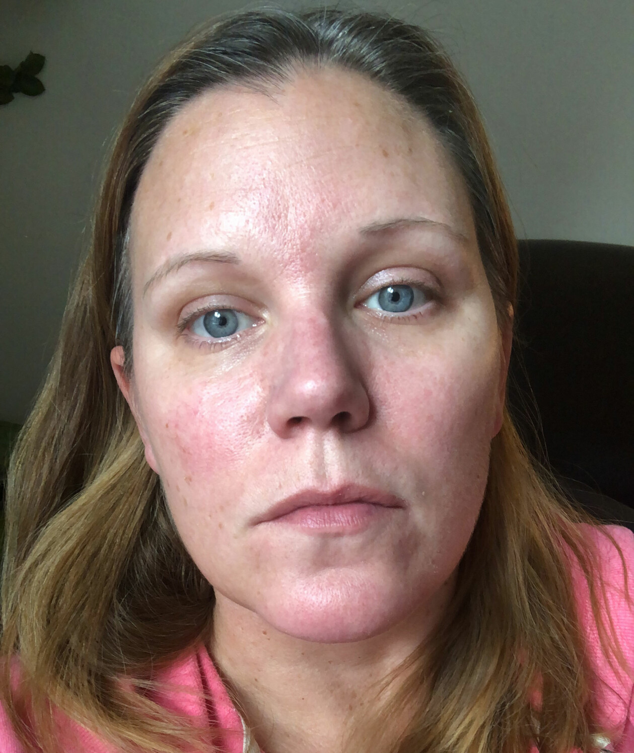 I början drabbades Anja ofta av frossa och blev väldigt varm kvällstid. Det resulterade ofta i kraftiga rodnader i huden. Anja L Sundberg är sjuk i covid-19 och tar en selfie för att visa upp rodnader i ansiktet.