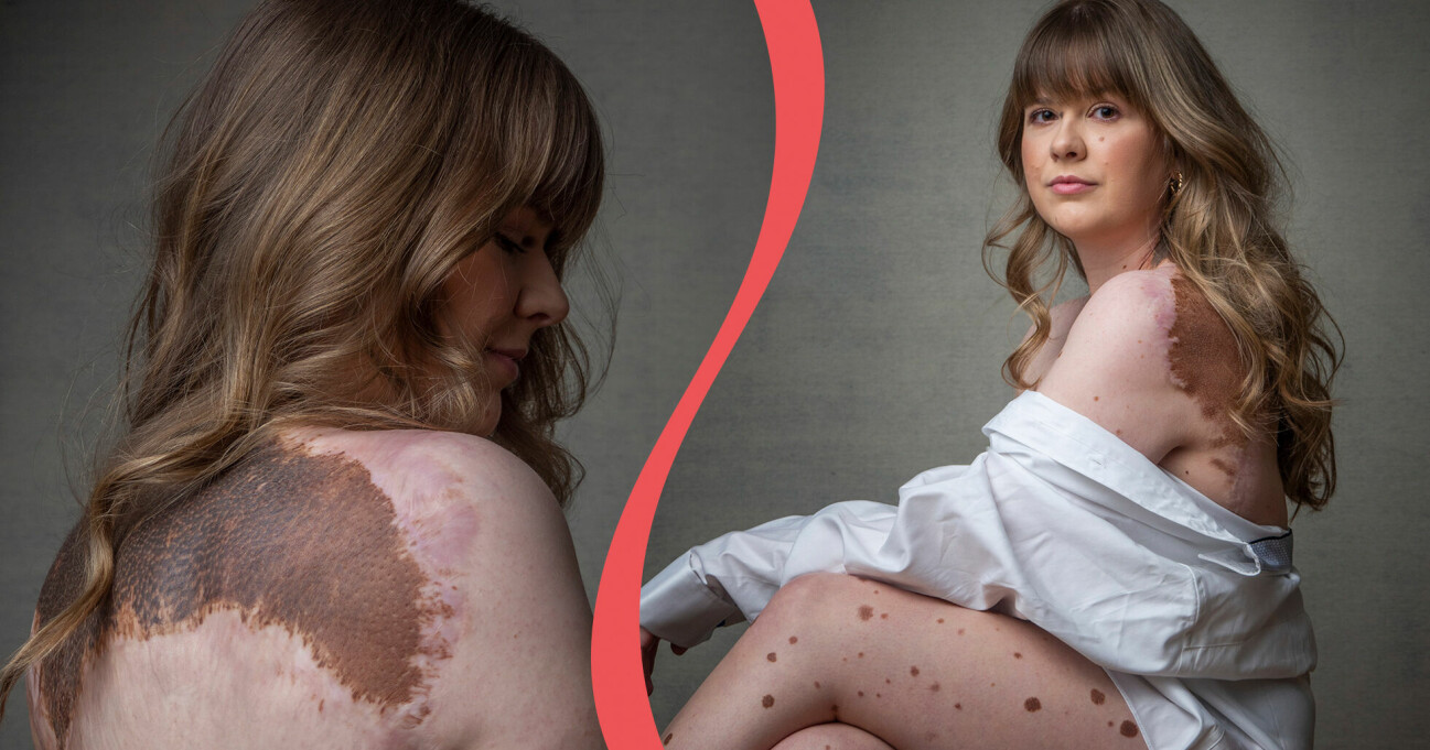 Vill vänster: Anna visar upp ryggen och huden med födelsemärken. Till höger: Anna poserar i skjorta och exponerade födelsemärken.