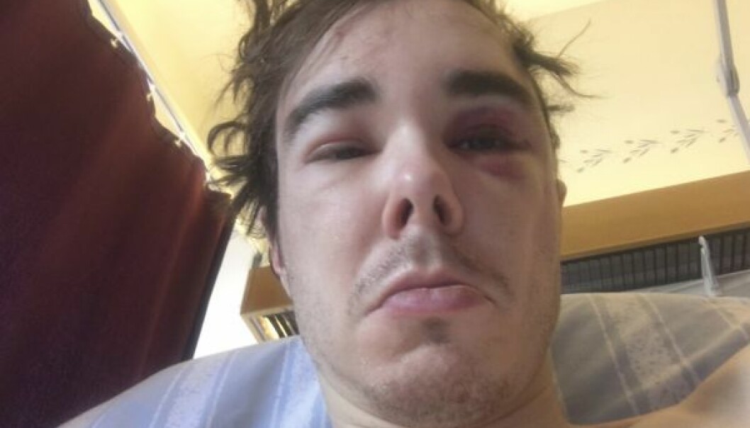 Patriks ena arm hade brutits, han hade flera sår i ansiktet och skrapsår över hela kroppen. Bild av Patrik efter olyckan, med blåmärken i ansiktet.