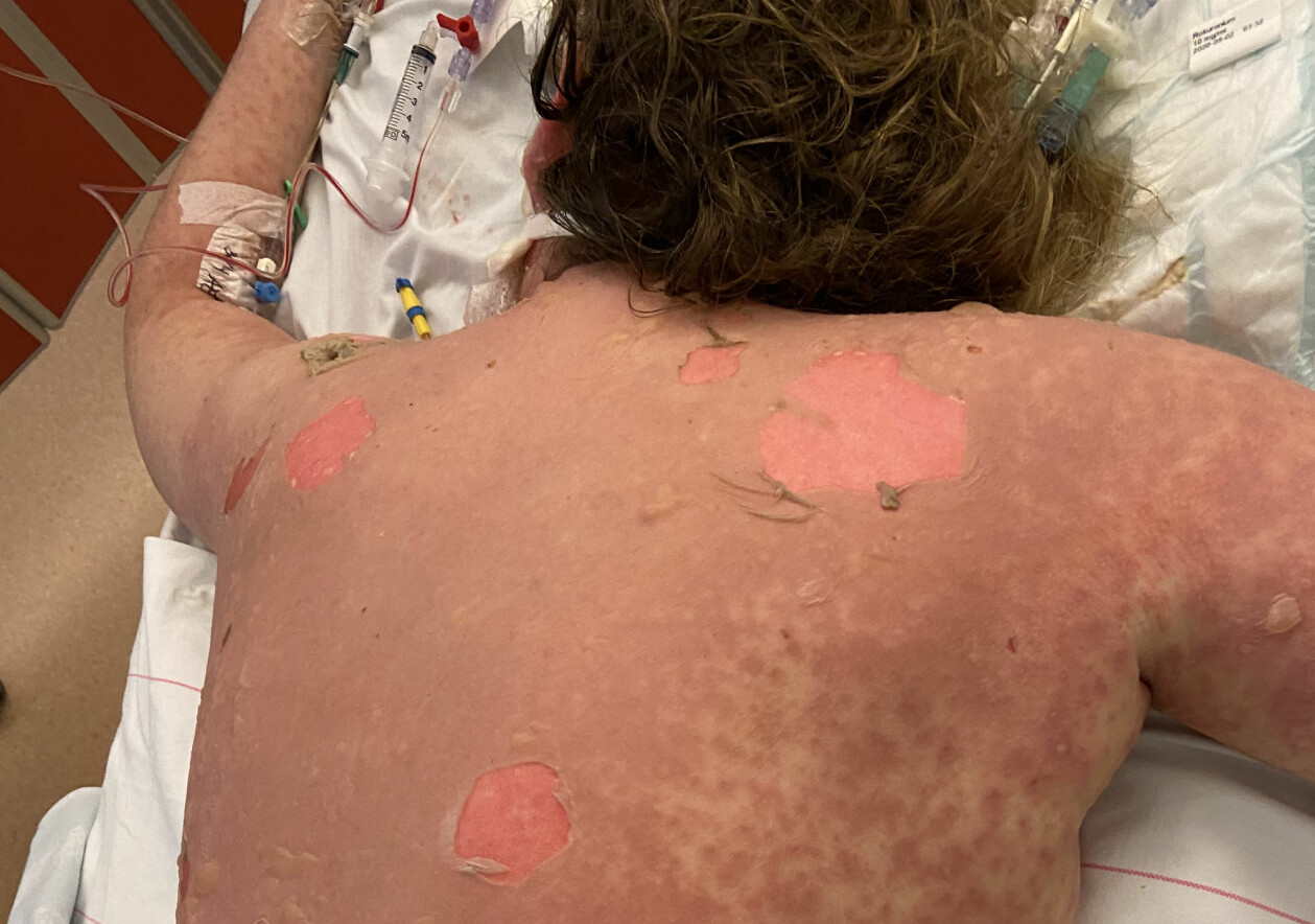 ”När jag låg där på IVA tänkte jag vilket fantastiskt jobb de gör”, säger Alva om sköterskorna. Den ovanliga sjukdomen som drabbade Alva Röine gjorde bland annat att hennes hud lossnade.