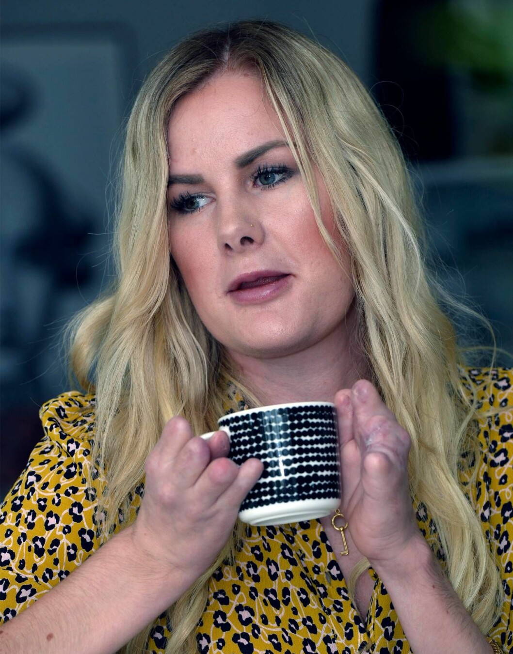 ”Det är värre att ha amputerat fingrarna än benen, menar Elin, som är fast besluten att leva ett normalt liv.” Elin, som drabbades av sepsis, håller i en kaffekopp mellan händerna som saknar fingrar.
