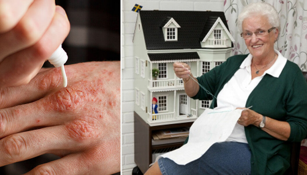Elisabeths psoriasis blev bättre med ny kräm