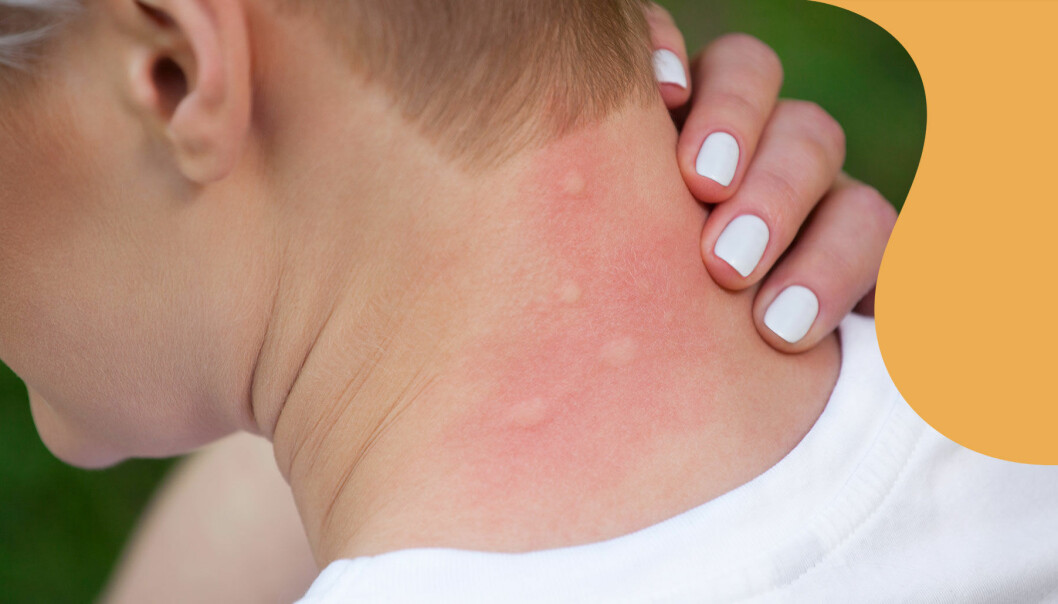En kvinna håller en hand om nacken, där hon har flera myggbett.