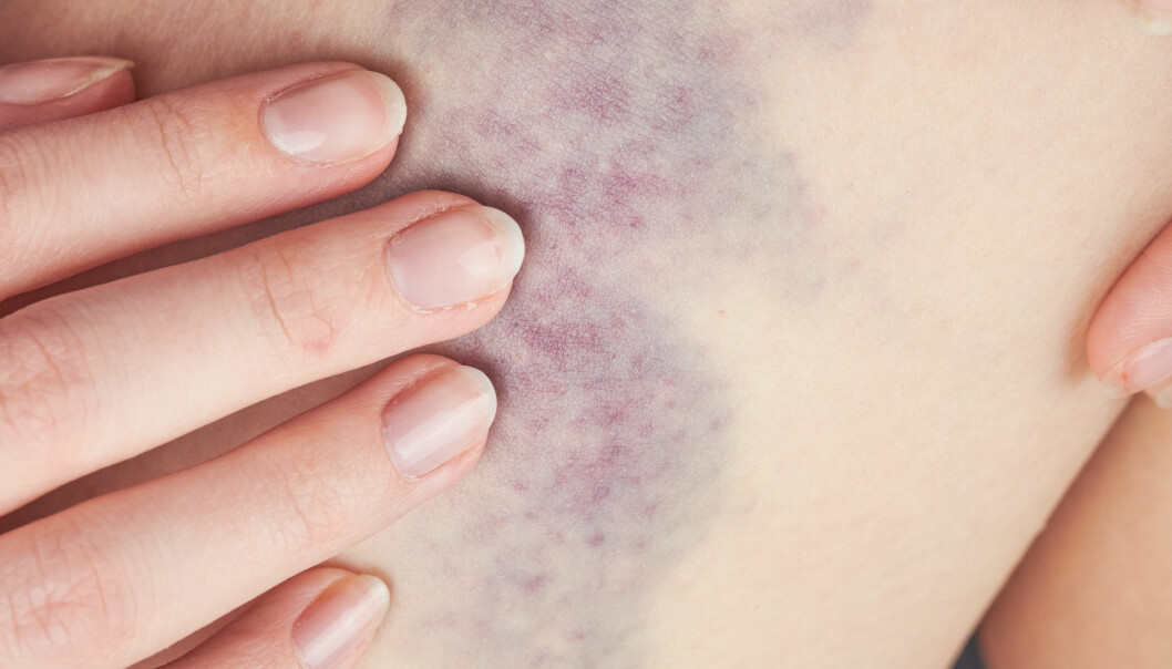 Ofta försvinner blåmärken av sig själv – men detta kan du göra för att snabba på processen. Foto: Shutterstock/TT En kvinna inspekterar ett blåmärke.