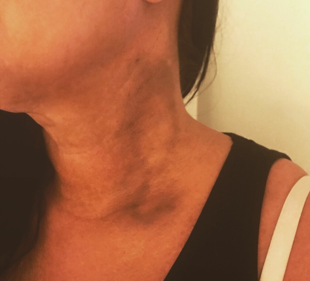 Misshandeln, både den fysiska och psykiska, blev en ständig följeslagare i Erika Praglers liv. Foto: Privat Erika Pragler med blåmärke på halsen efter en misshandel.
