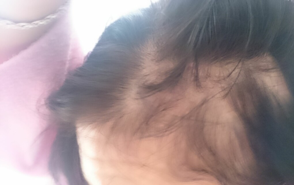 Vid ett tillfälle drog pojkvännen bort så mycket hår att partier av hjässan blev kala. Foto: Privat Erika Pragler visar hur ett parti på hjässan är hårlöst efter en misshandel.