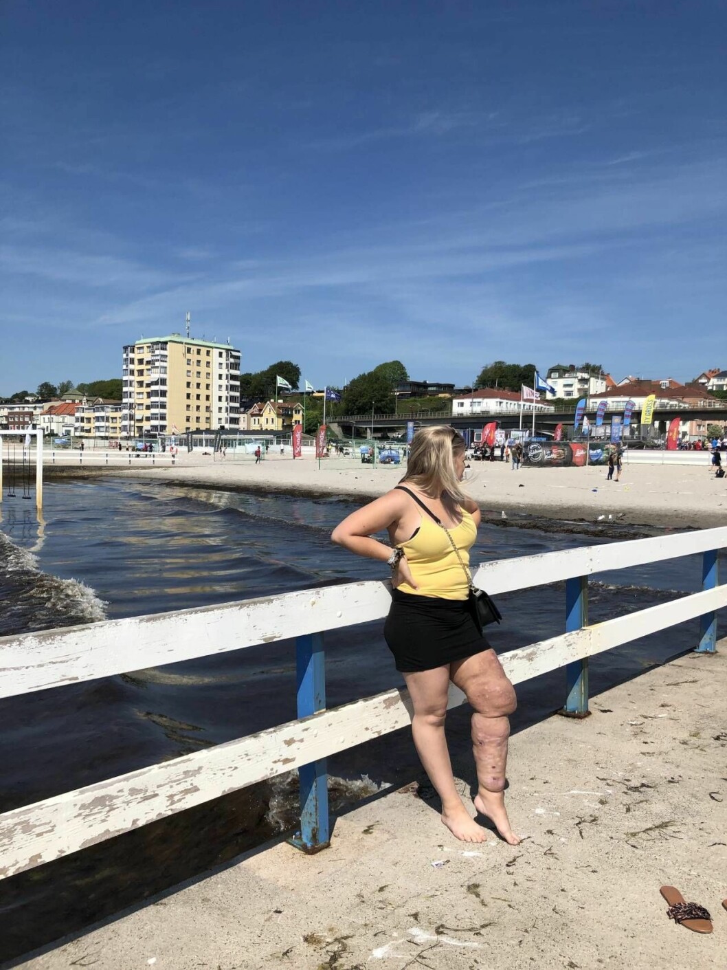 Fanny Fallesen är trött på att ta emot kommentarer från både unga och vuxna på grund av att hennes ben ser annorlunda ut. Foto: Privat Fanny Fallesen på stranden.