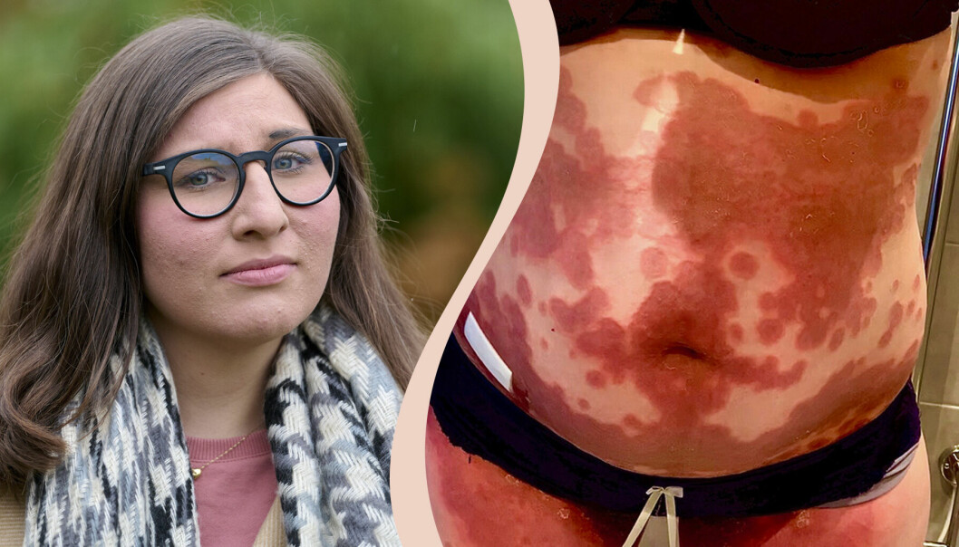 Delad bild, Gabriella Strand som fick graviditetspemfigoid, och en bild på hennes rödflammiga kropp.