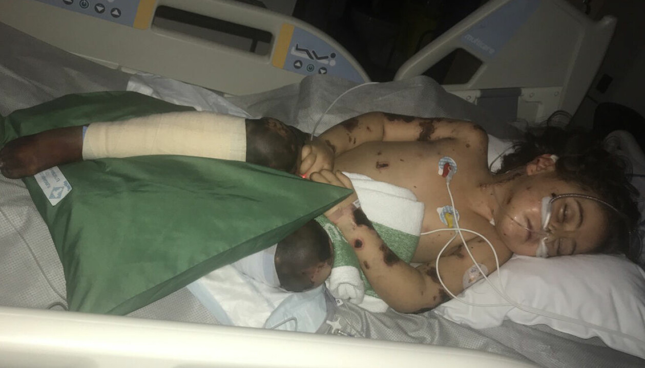 Gabriellas liv hängde på en skör tråd Gabriella svårt sjuk i sjukhussäng med slangar och svarta märken över kroppen och benen.