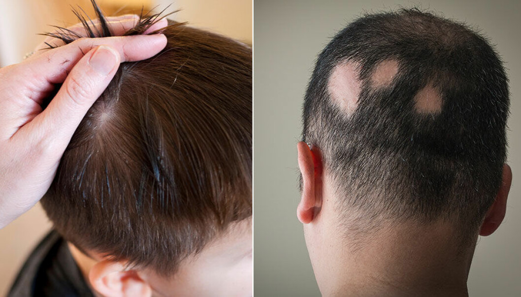 Alopecia areata, fläckvis håravfall