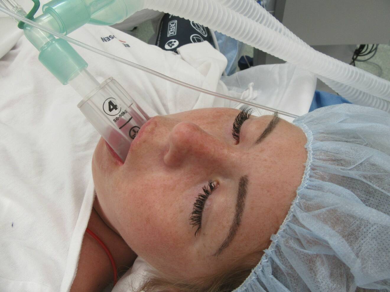 Hanna Öhman har genomgått över 30 operationer för sin förlossningsskada. Här nedsövd på operationsbordet.