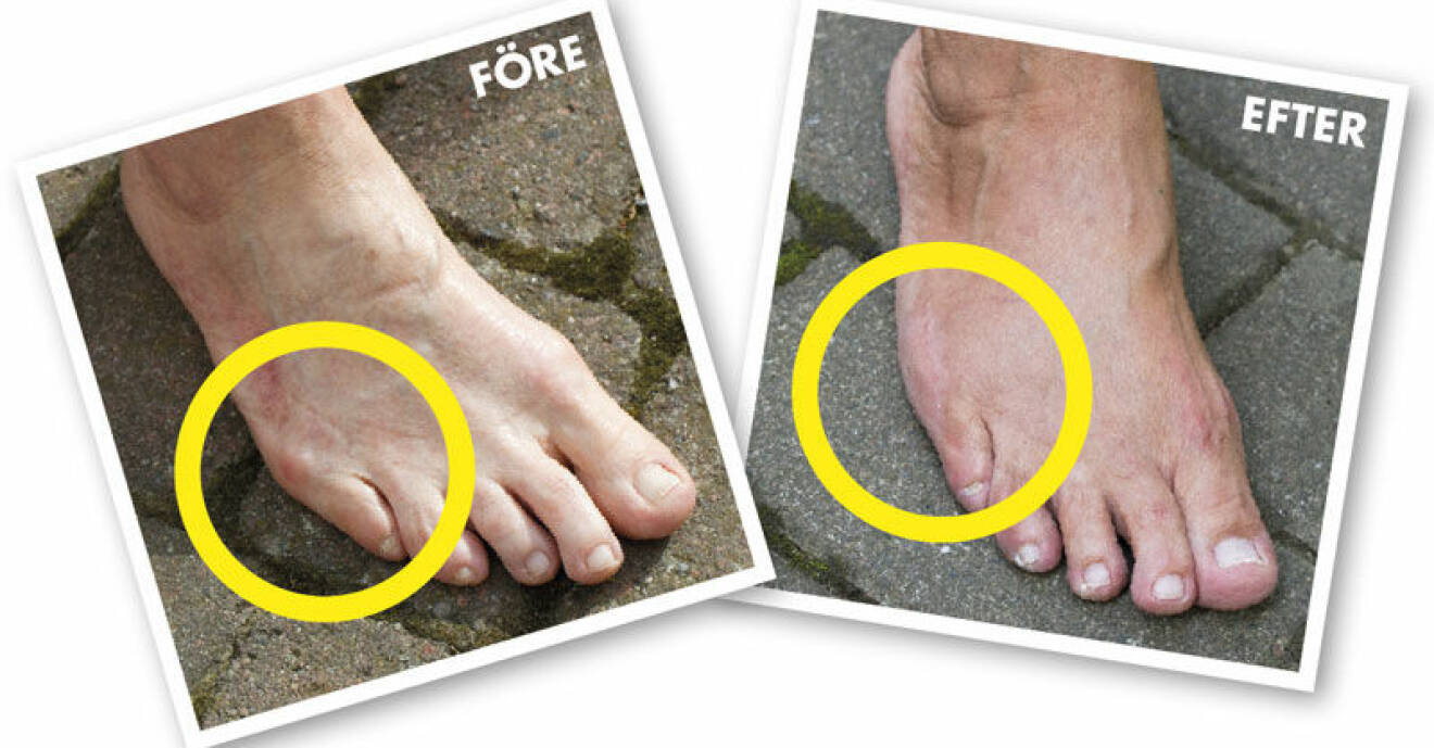 Fotproblem skräddarknuta – före och efter operation.