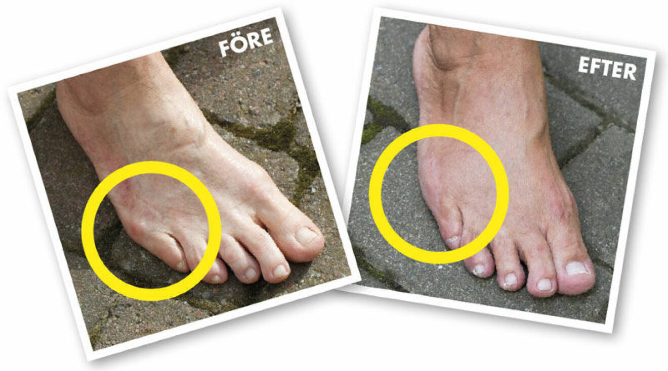 Foten före och efter operationen för skräddarknuta
