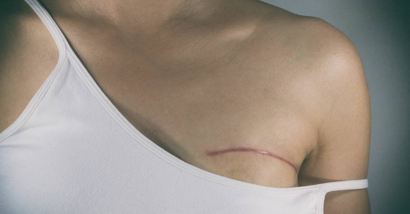 En kvinna med ett ärr efter att ha opererat bort en bit av bröstet efter att ha fått bröstcancer.