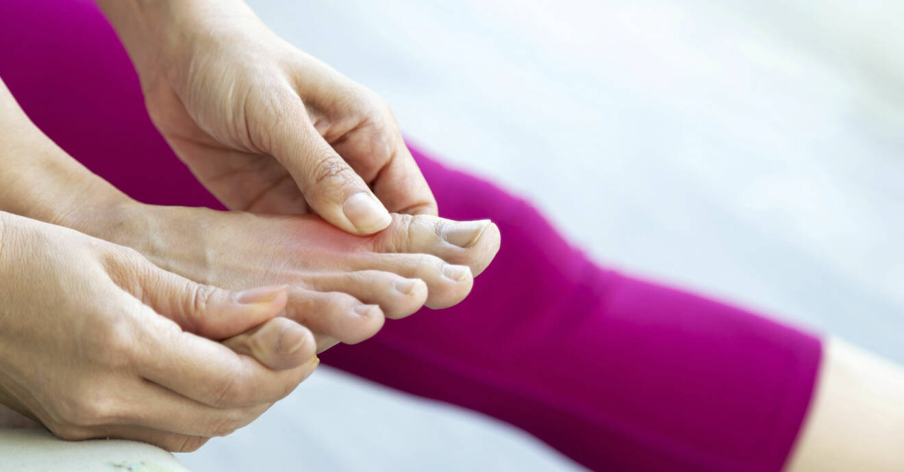 Stortå drabbad av gikt, arthritis urica, som också kallas portvinstå.