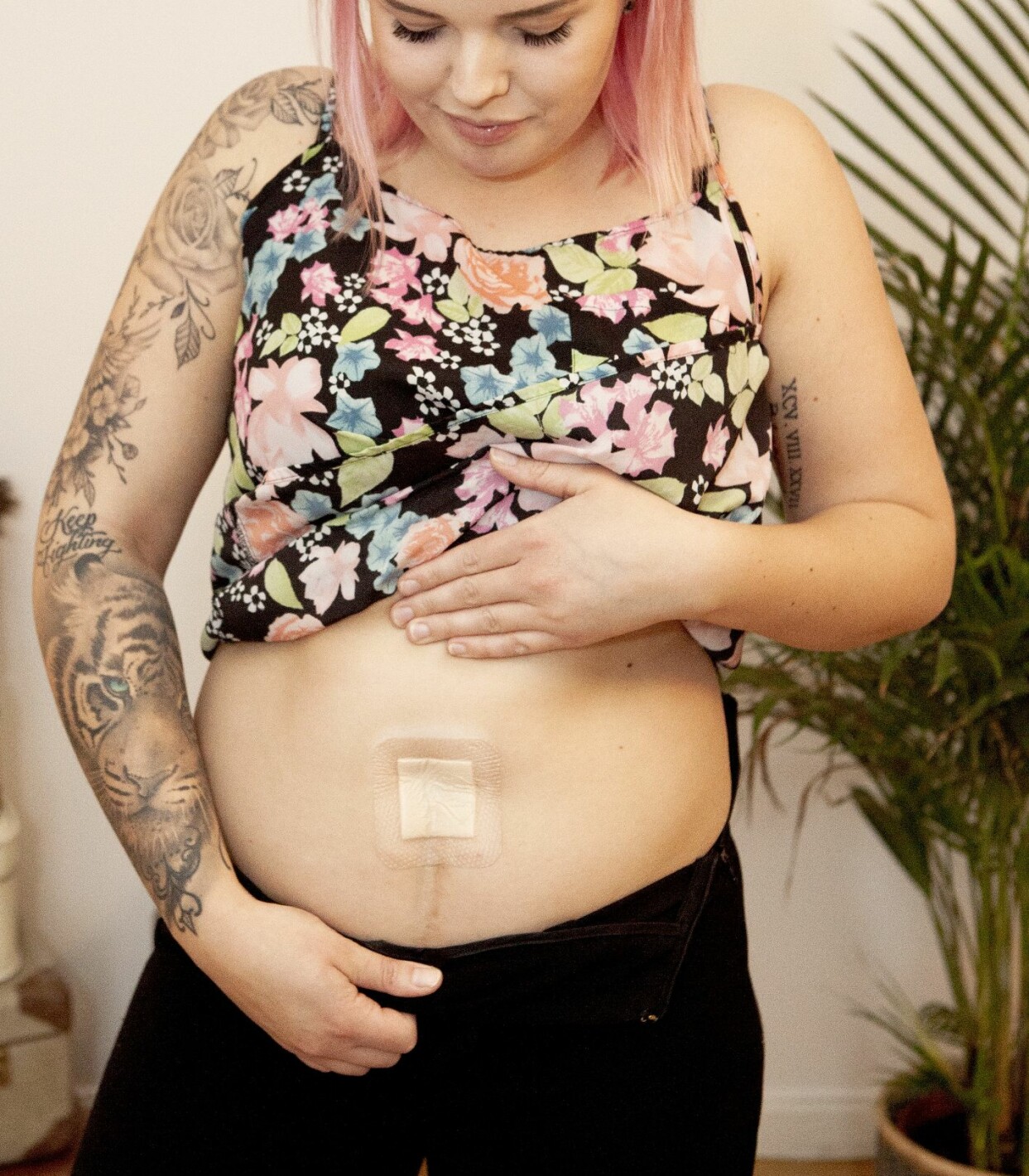 Jennie är stolt över att hon vågat visa och berätta om sin sällsynta sjukdom blåsextrofi. Foto: Frida Ekman Jennie, som lider av blåsextrofi, visar upp sitt plåster på magen.