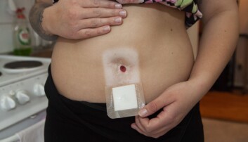 Istället för en navel syns ett litet runt hål under Jennies plåster över naveln. Foto: Frida Ekman Jennie visar sitt hål i magen genom vilket hon kissar.