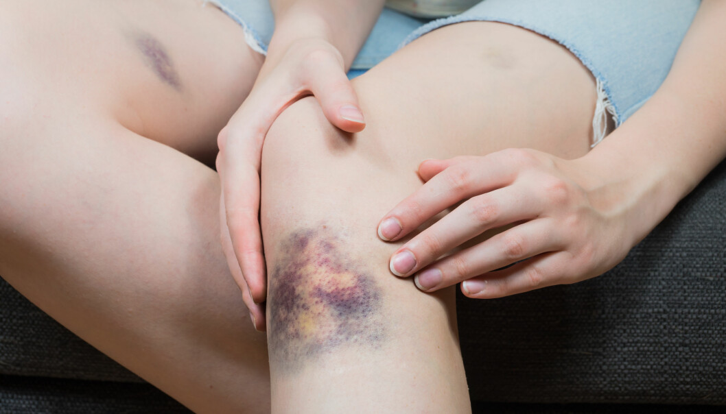 Kvinnor får lättare blåmärken än män. Foto: TT/Shutterstock Kvinnor får lättare blåmärken än män. Här visar en tjej upp ett rejält blåmärke på smalbenet.