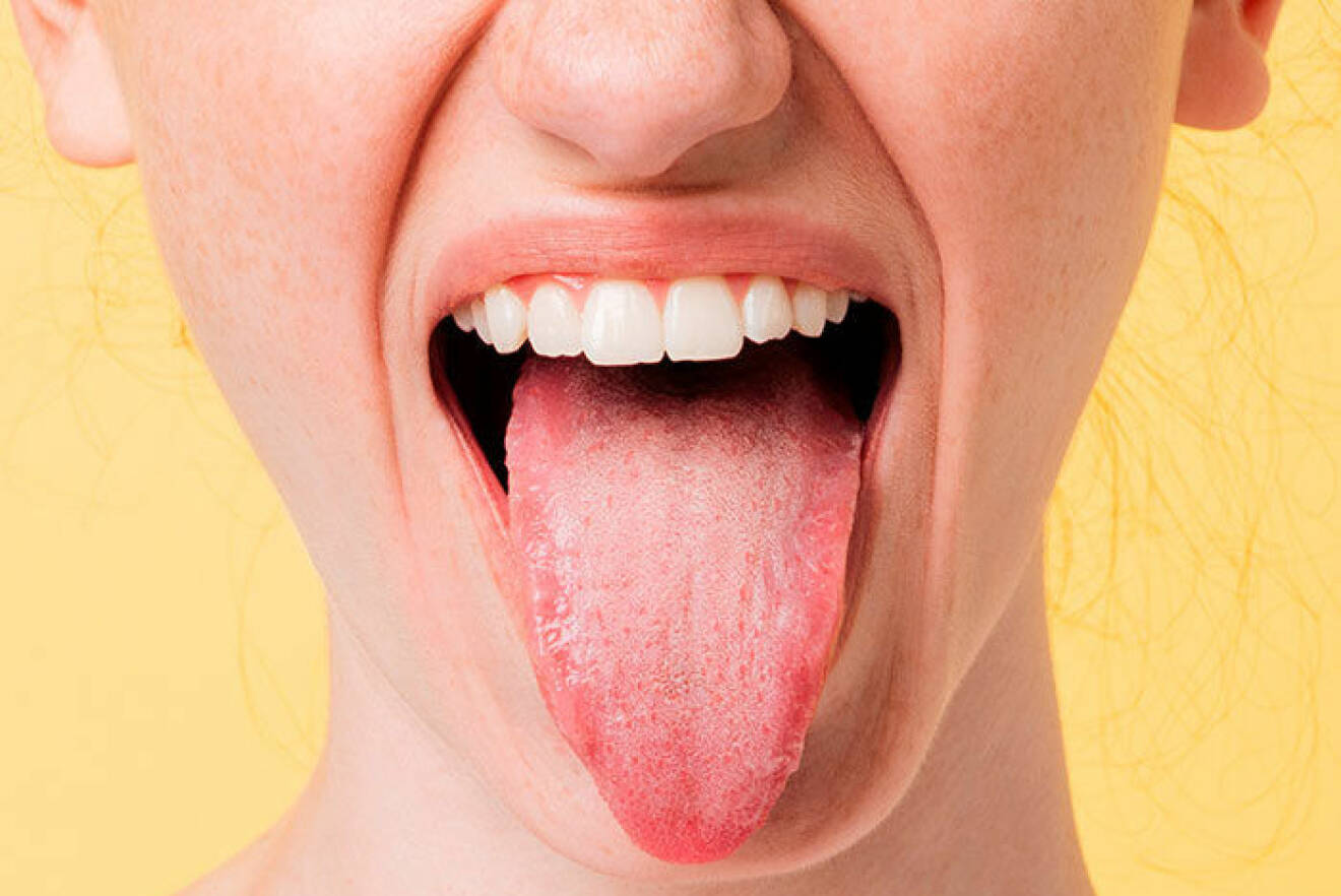 Kvinna räcker ut tunga som är täckt av vit/gul beläggning.