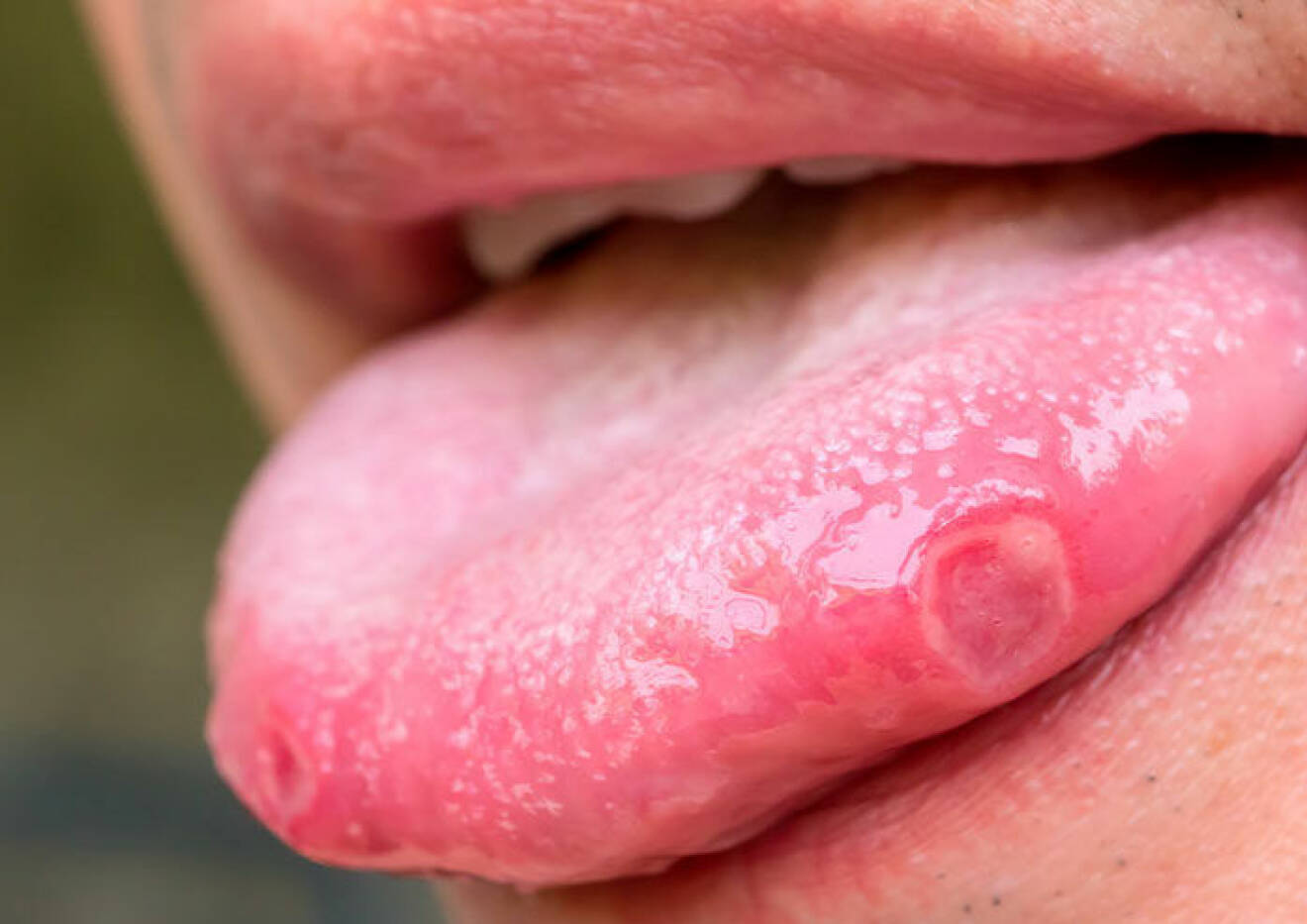 Person med blåsor på tungan.
