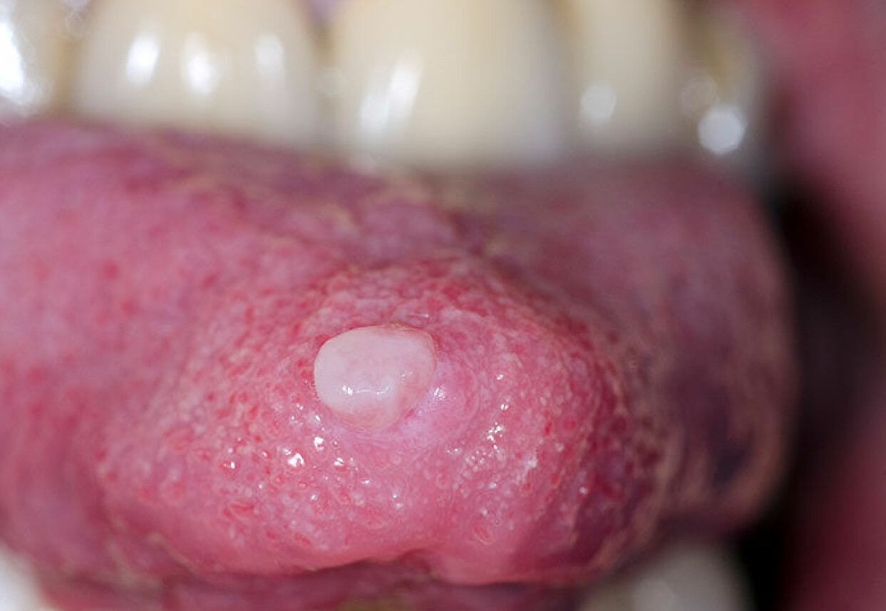 En polyp är ofta inget farligt, utan går att ta bort av en tandläkare eller läkare. Polyp på tunga.