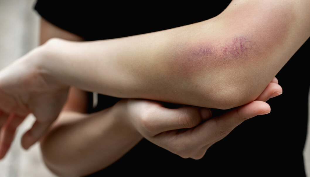 Kvinnor och äldre får enklare blåmärken. Foto: Shutterstock/TT En kvinna har fått ett blåmärke på armbågen.