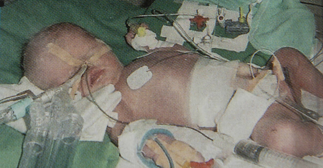Adam, som knivskars när han låg i sin mammas mage, vårdas på sjukhus.