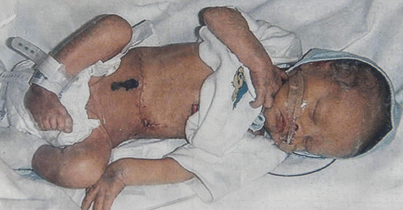 Lille Adam som skadades i en kvinattack när han låg i sin mammas mage.