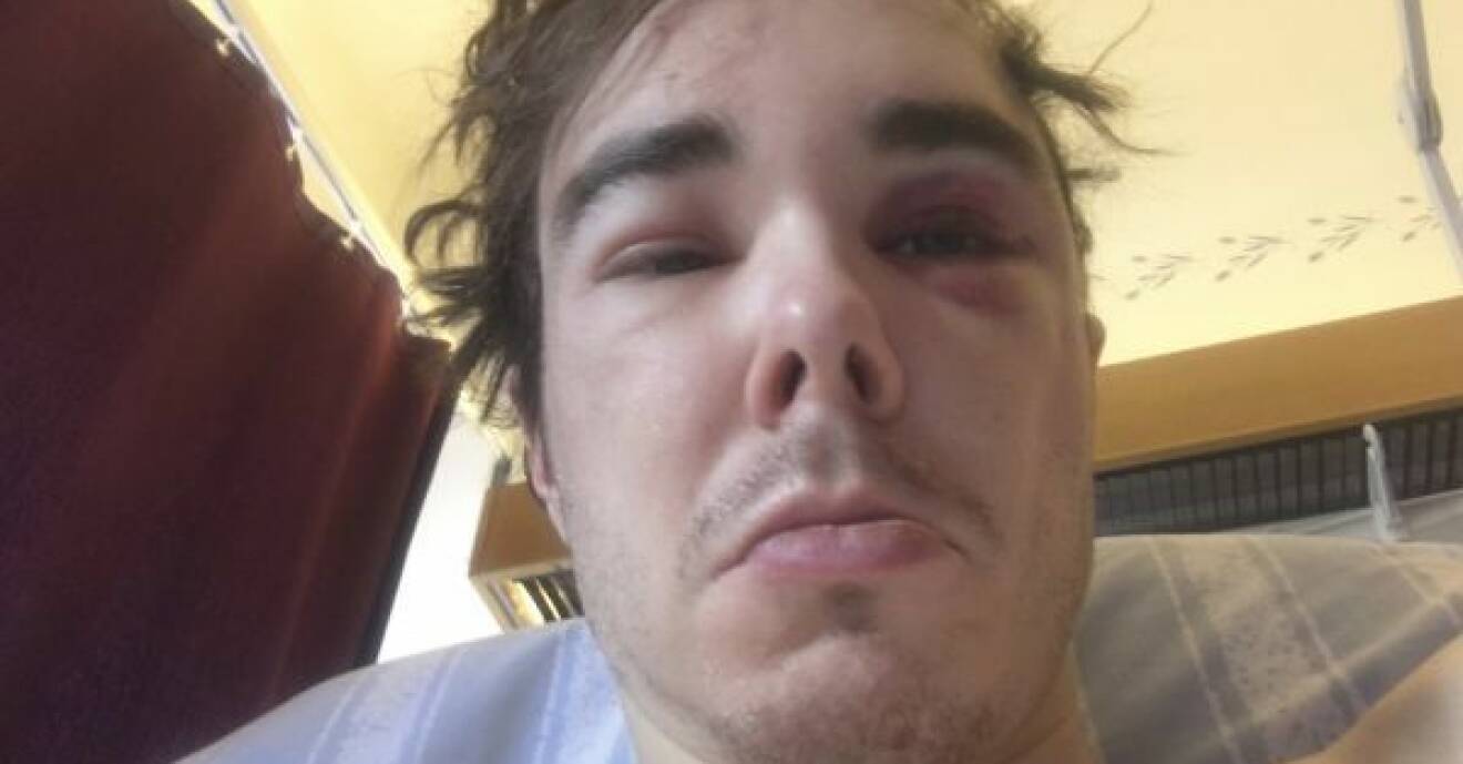 Bild av Patrik efter olyckan, med blåmärken i ansiktet.