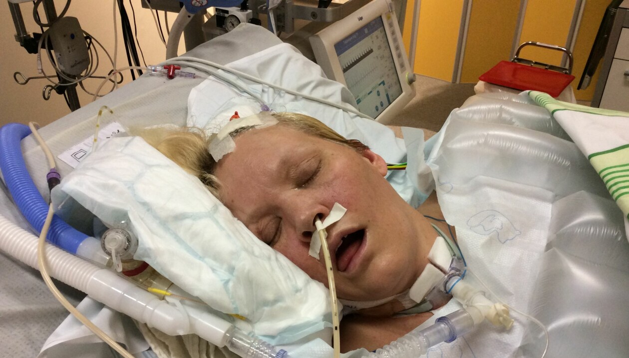 Efter den första stroken fick Åsa lunginflammation och en propp i armen. Foto: Privat Åsa ligger nedsövd på sjukhus med en slang i näsan.