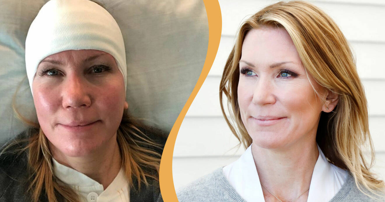 Jenny Alversjö opererades igen efter en stroke i höstas.