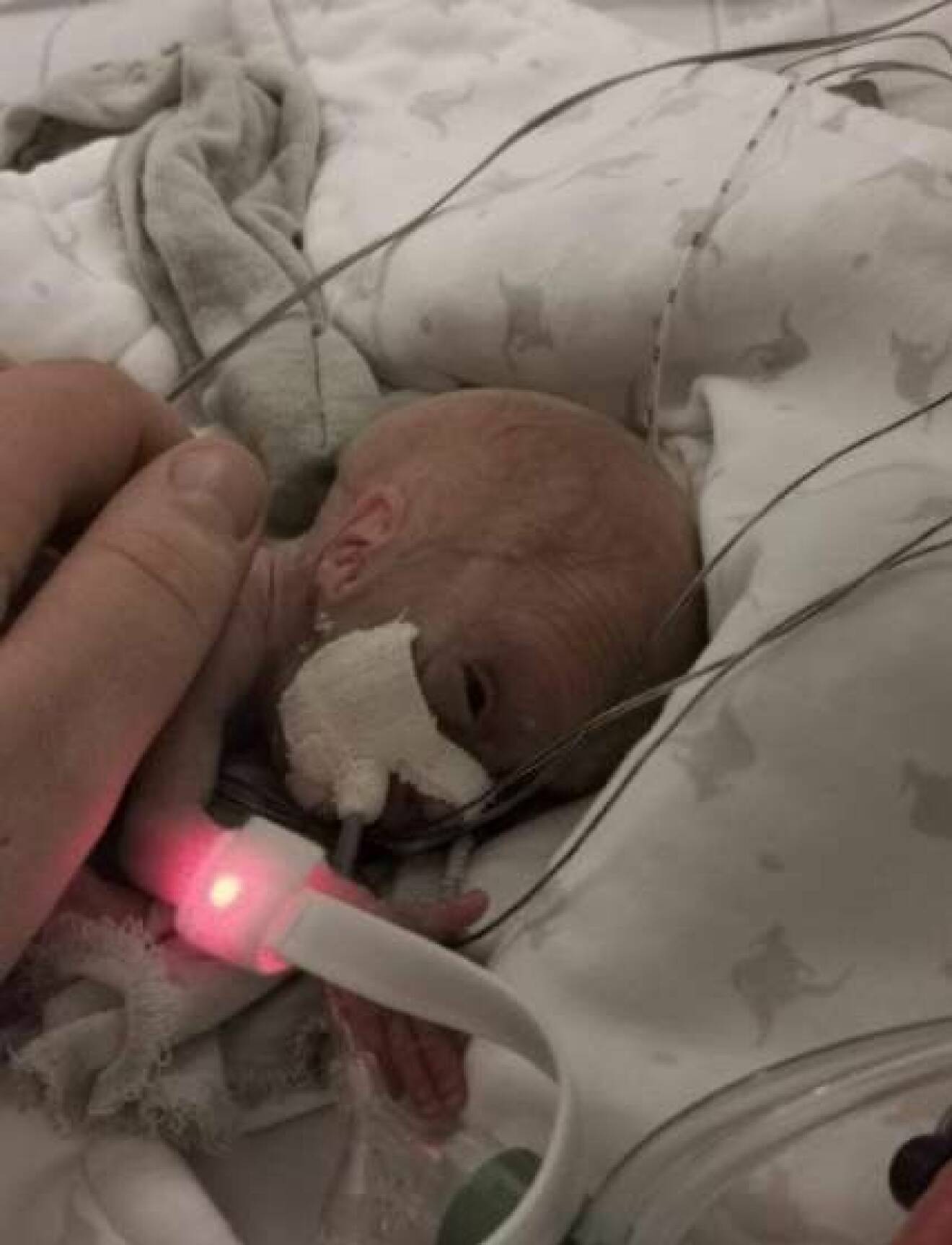 En för tidigt född liten flicka ligger med syrgasslangar i näsan i en sjukhussäng.